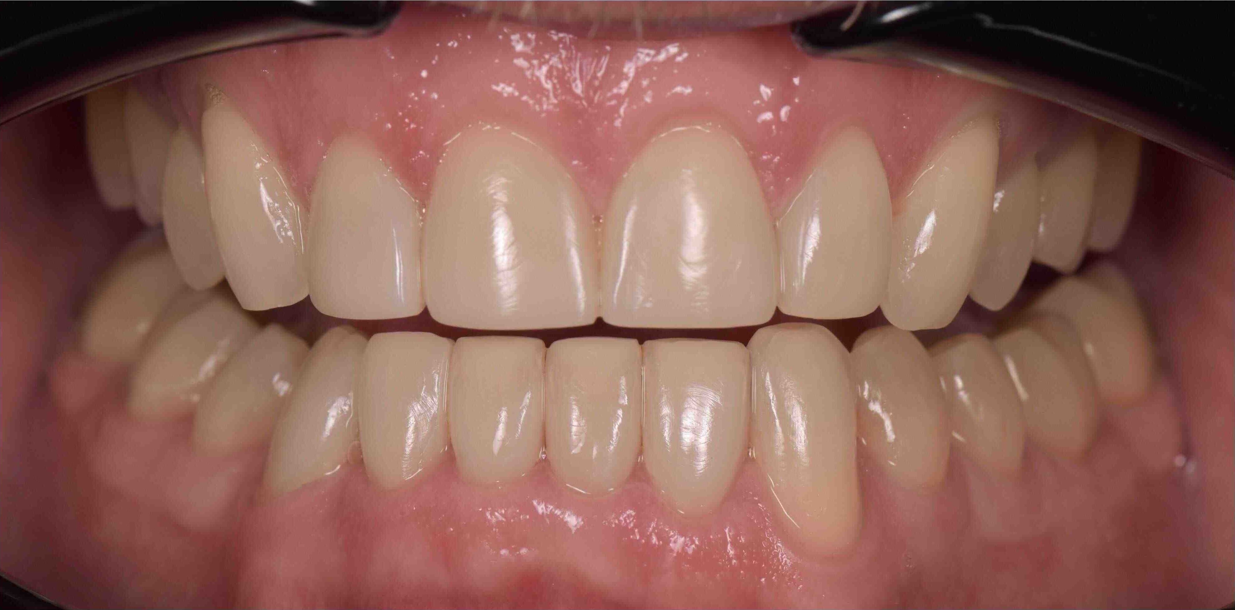 Invisalign and whitening transformation